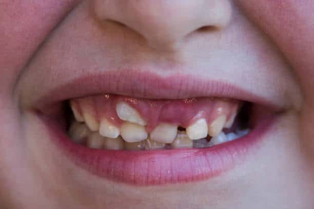 child smiling with shark tooth on upper incisor ectopic eruption