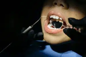 Thumbnail pexels-cottonbro-6502542 for What Are “Shark Teeth” and Should You Be Concerned?