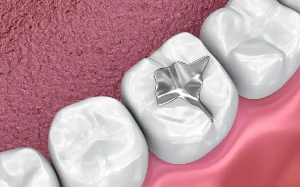 dental fillings can help food traps bradford family dentistry