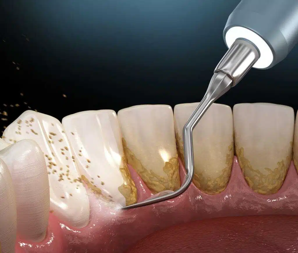 remove plaque
