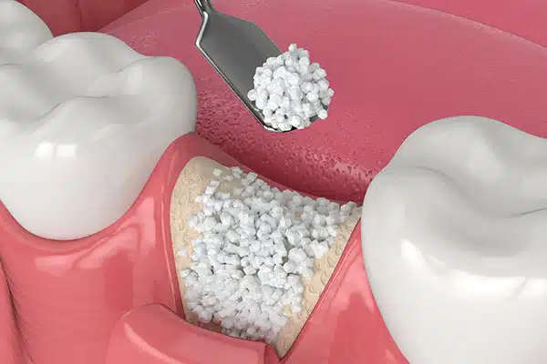 3d,render,of,dental,bone,grafting,with,bone,biomaterial,application